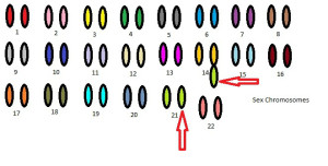 Karyotype of Translocation Down Syndrome